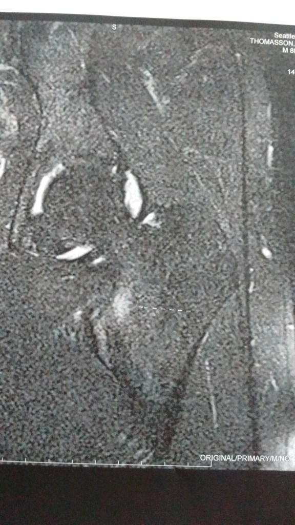 A Broken Hip: Part&nbsp;2